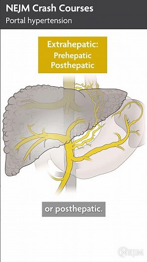 NEJM Crash Courses: Portal Hypertension