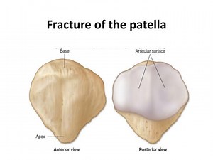 Fracture of the patella - SlideServe