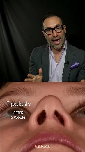 Tipplasty (Nasal Tip Rhinoplasty) Explained by Dr. Kian.