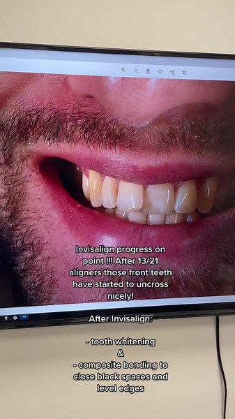 Invisalign Progress: Straightening Crossed Front Teeth