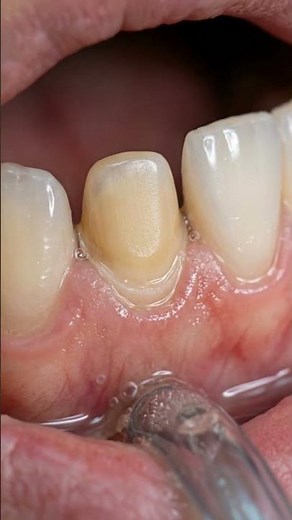 Dental Crown Restoration | Silver Crown Placement Animation #shorts