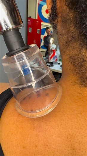 4.8K views · 86 reactions |  Cupping therapy uses suction to lift and decompress layers of fascia and muscle, helping improve blood flow, reduce stiffness, and ease deep muscle tension. Great for recovery and stress relief—sometimes you need to pull to release. #CuppingTherapy #MyofascialRelease #ChicagoChiropractic #ChiropracticCare #drkyleross | Dr_kyleross | Facebook