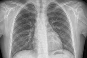 CLOUD APP FOR PNEUMONIA DETECTION WITH  X-RAY IMAGES IN DL