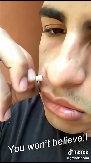 Watch This Giant Pimple Get Popped!