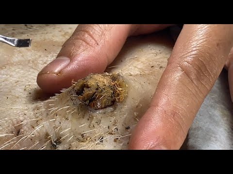 [ASMR] facial Armpit Cyst Extraction – Dr. Pimple Popper’s Most Satisfying Removal 3010M3