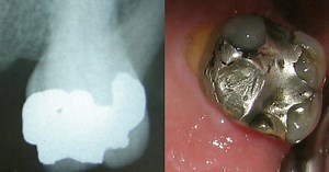MCQs on Dental Materials : Amalgams Part 1