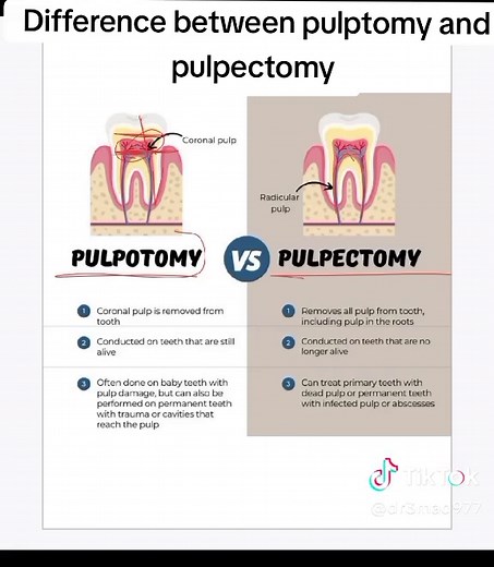 Difference between pulpotomy and pulpectomy #dentistry #dental #dentalhygienist #dentalstudent #student #dentistryworld #facultyofdentistry