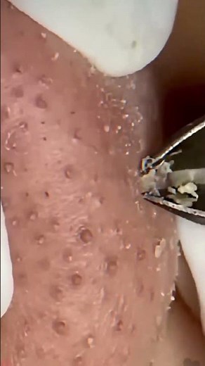 Skincare ｜ Blackheads Removal #tweezer #skincare #blackheads 15
