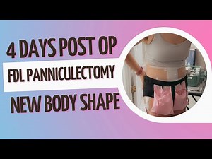 4 days post FDL Panniculectomy surgery!