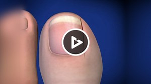 Winograd Procedure for Ingrown Toenail