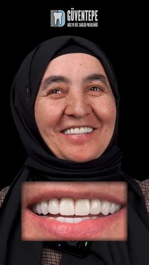 Gülüş Tasarımı Nedir / Öncesi ve Sonrası