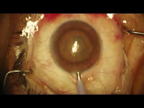 Surgery: Phacoemulsification: Dr. Stephen Lane