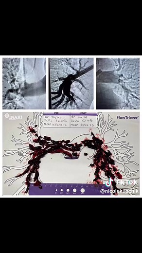 This is a massive pulmonary embolism from a lower extremity DVT that was treated with mechanical thrombectomy using the Inari device. This device has been an absolute game changer! There is only so much fibrinolytics can do! Check out the patients before & after PaO2 levels & PA pressures: PaO2 - before: 32.6 after: 50.6 PA pressures - before: 63/23 (40) after: 33/17 (23) Pretty amazing! # pulmonaryembolism #nurse #nurselife #criticalcare #criticalcarenurse #cathlab #interventionalist #emergency