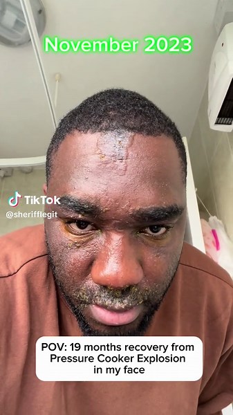 Recovery from pressure cooker explosion in my face 🥰 | Pressure Cooker