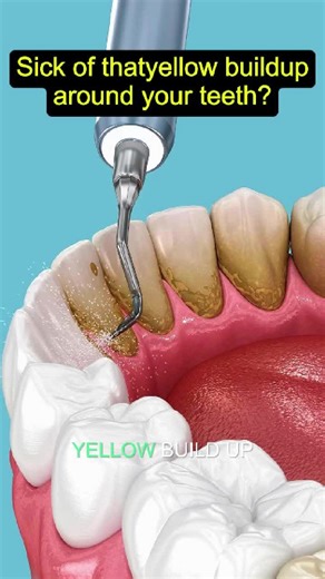 Ultrasonic Electric Tooth Cleaner for Effective Plaque Removal