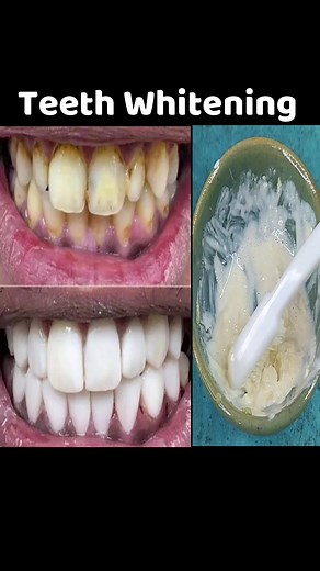 Teeth whitening naturally in just 3 minutes #teethwhitening #whiteteeth | Simple Home Remedies