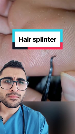 Effective Hair Splinter Removal Methods | Medical Tips