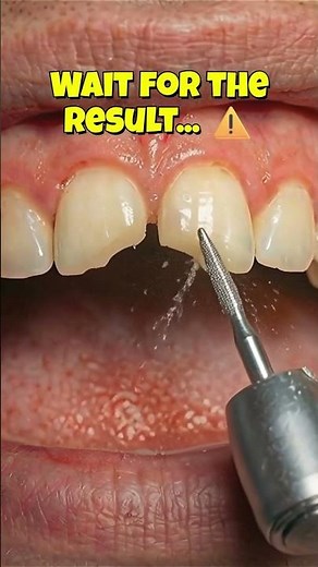 Satisfying Broken Tooth Repair 🦷✨