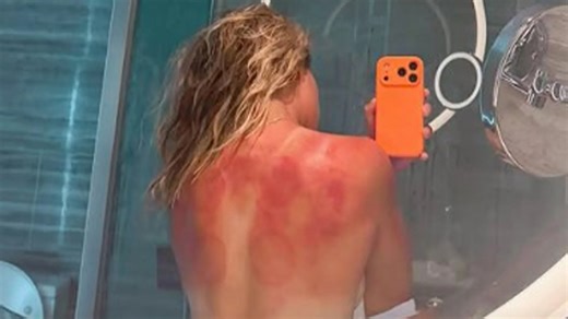 Tennis star shares topless picture after severe sunburn in Australian Open prep