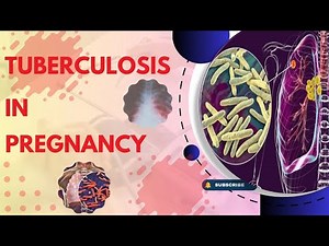 Tuberculosis in Pregnancy; Causes, Symptoms, Diagnosis, Treatment and Pathology | TOG Article