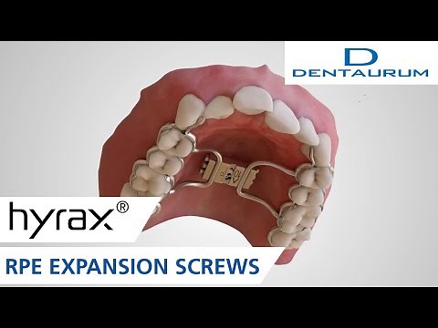hyrax® neo expansion screws for palatal expansion