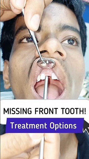 Lost a Front Tooth in an Accident? Here's the Best Treatment Option