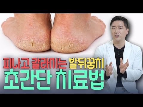 피나고 갈라져서 통증이 심한 발뒤꿈치!? 집에서 매우 간단하게 치료 가능⭐ 피부과 전문의가 그 방법을 알려드립니다