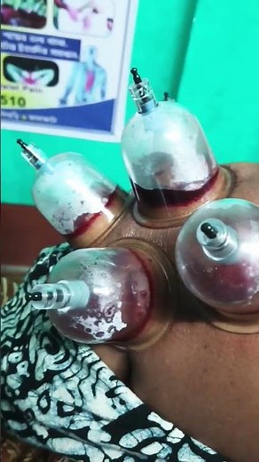 blood cupping treatment #video # Siliguri