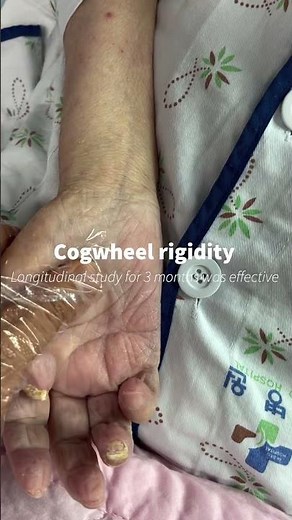 Longitudinal study about Cogwheel rigidity was effective too for 3months
