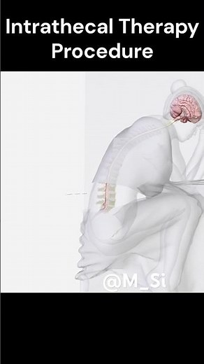 Intrathecal therapy procedure