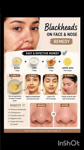 Blackhead Removal at Home 🖤✨ #aaru #skincare