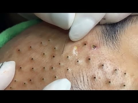 Treat Blackheads And Hidden Acne On The Forehead at Sac Dep Spa