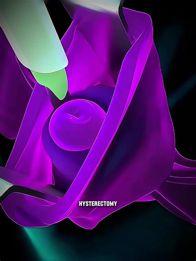 Hysterectomy Surgery Explained: Why the Uterus Is Removed? #hysterectomy #womenshealth #gynecology #medicalanimation