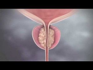 Prostate Steam Treatment - Rezum Water Vapour Therapy for BPH