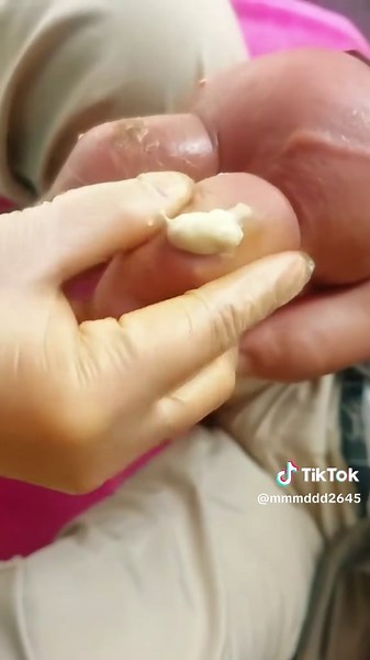 #extrusion #the #treatment #eliminate #fypツ #clearskin #goutytophi #gout