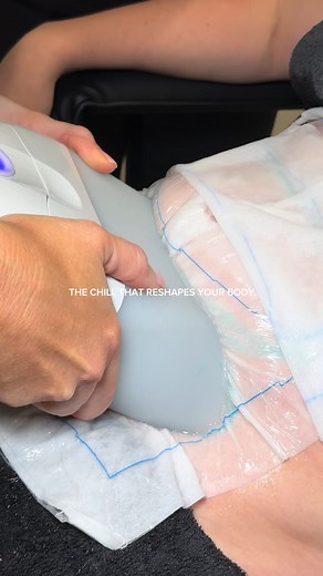 Fat Freezing: Permanent Reduction of Fat Cells