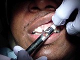 Almost Pain Free Local Anesthesia Anterior Maxilla: Step 1 • Video • MEDtube.net