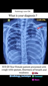 Radiology case-156 A 20 year female Patient presented with cough with sputum, Shortness of breath and weakness.. What is your diagnosis? #viralreels #reels #radiographer #medico #radiology #reelsinstagram #xray #mbbs #medicos #medicogirl #radiología #radiografías #medicostudent #médico #pulmonologists #pulmonology #viralreels #fby #fbreels | Diwakar Patel
