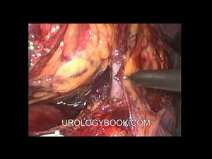 Laparoscopic Radical Nephrectomy • Video • MEDtube.net