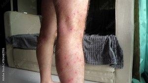 Close-up view of man leg with visible mosquito bites in domestic setting, indicating common insect bites and skin irritation. Domestic health and first aid.