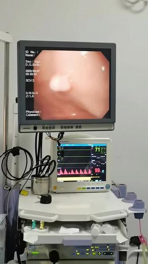 没什么症状，正常体检，发现约8mm大小息肉，行内镜下EMR术切除.#胃底息肉 #微创手术