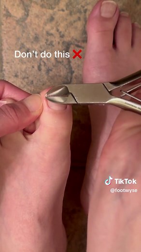 Proper Toenail Care: Trim Straight to Avoid Ingrown Nails