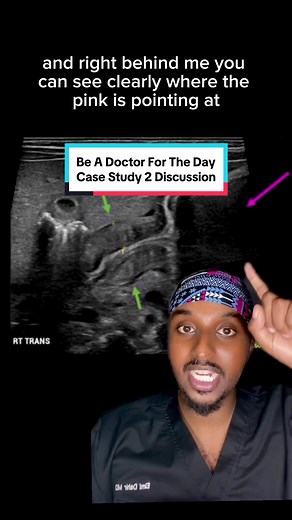 Pyloric Stenosis in Infants: Diagnosis and Treatment Explained