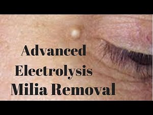 Milia , White Head Removal