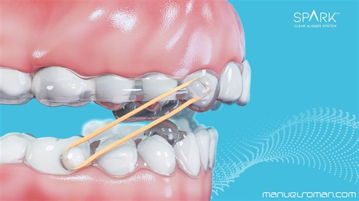 Spark BiteSync: Avance mandibular con Spark ortodoncia invisible