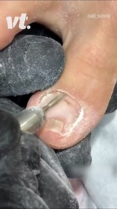 This toe nail transformation is unbelievable! 😱 | VT