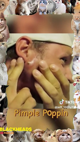 Effective Methods for Relieving Pimple Pain