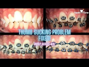 Thumb sucking dental issue fixed - Video # 3 Progress pictures - Tooth Time Family Dentistry Texas