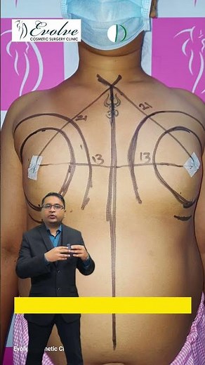 Male Breast Implant Surgery | 410cc Implants with Sub-Fascial Approach | Dr. Samir