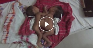 Conjoined Twins Born in India